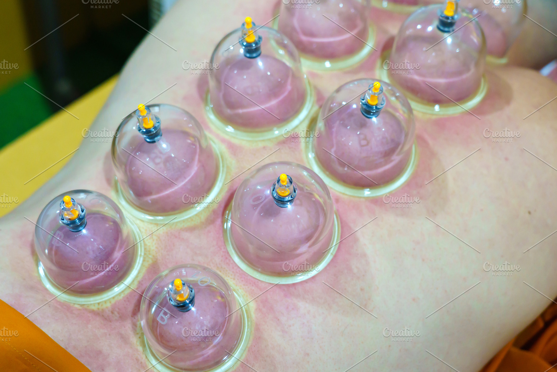 Close up for multiple vacuum cups, medical cupping therapy on hu, a Health & Medical Photo by Casanowe-studio
