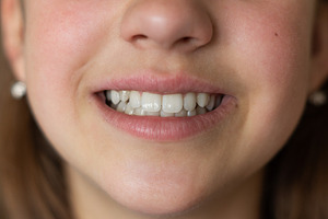 Child's white teeth close up, a Health & Medical Photo by Nastya_Velko