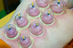Close up for multiple vacuum cups, medical cupping therapy on hu, a Health & Medical Photo by Casanowe-studio