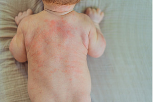 Severe heat rash on newborn baby, a Health & Medical Photo by Elizaveta Galitskaya