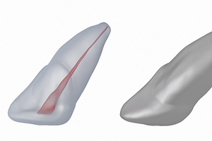 Upper Central Incisor With Pulp