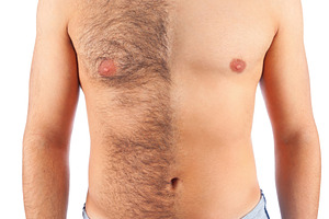 Man showing his chest before and after hair removal treatment, an Abstract Photo by Antonio Gravante Market