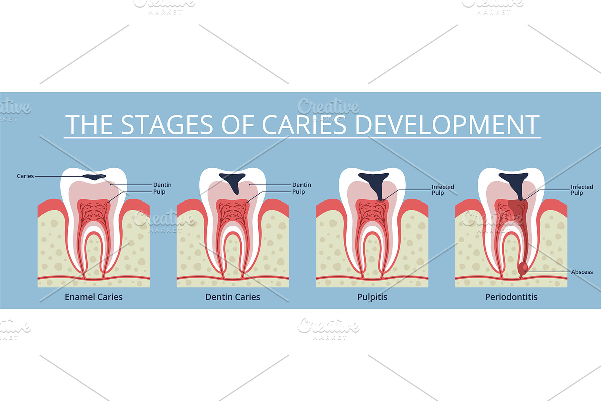 Caries stages. Gradual tooth decay, an Object Illustration by YummyBuum