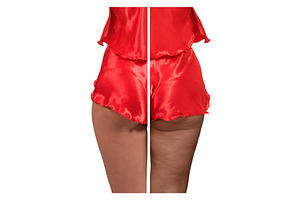 Woman's thighs and buttocks with, a Health & Medical Photo by Jan Jack Russo Media