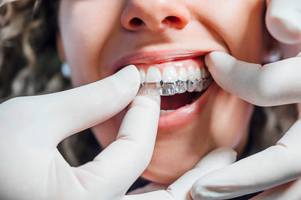 Doctor putting a clear dental aligne featuring woman, girl, and hand, a Health & Medical Photo by karrastock