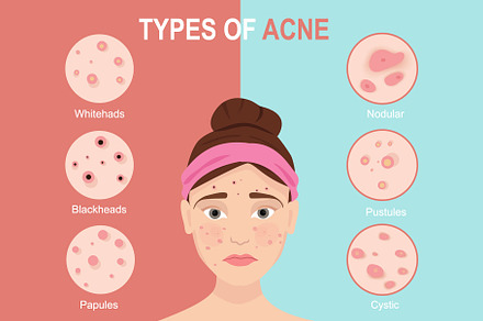 Types of acne. Skin problems, an Illustration by Viktorijareut