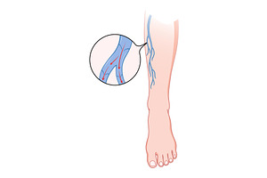 Varicose veins. Blue blood, an Object Illustration by Things for designers