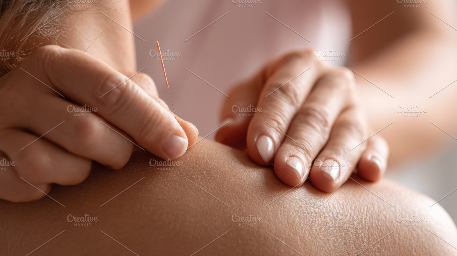 Shoulder acupuncture healing, a Photo by Beautiful things