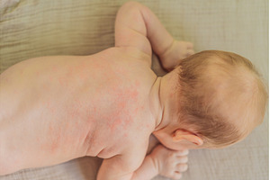 Severe heat rash on newborn baby, a Health & Medical Photo by Elizaveta Galitskaya