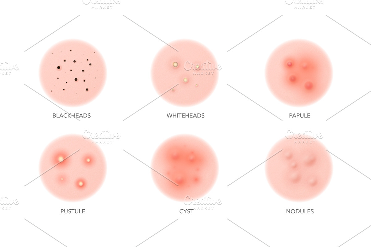 Acne types, body or face skin, a Healthcare Illustration by Vector Tradition