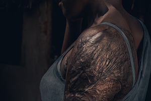 African Burn Victim