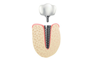 Dental implant structure. Medical, a Healthcare Illustration by the8monkey