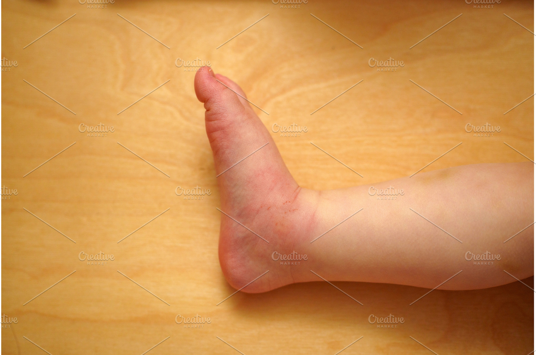 A child leg shows noticeable redness, a Person Photo by darksoul72