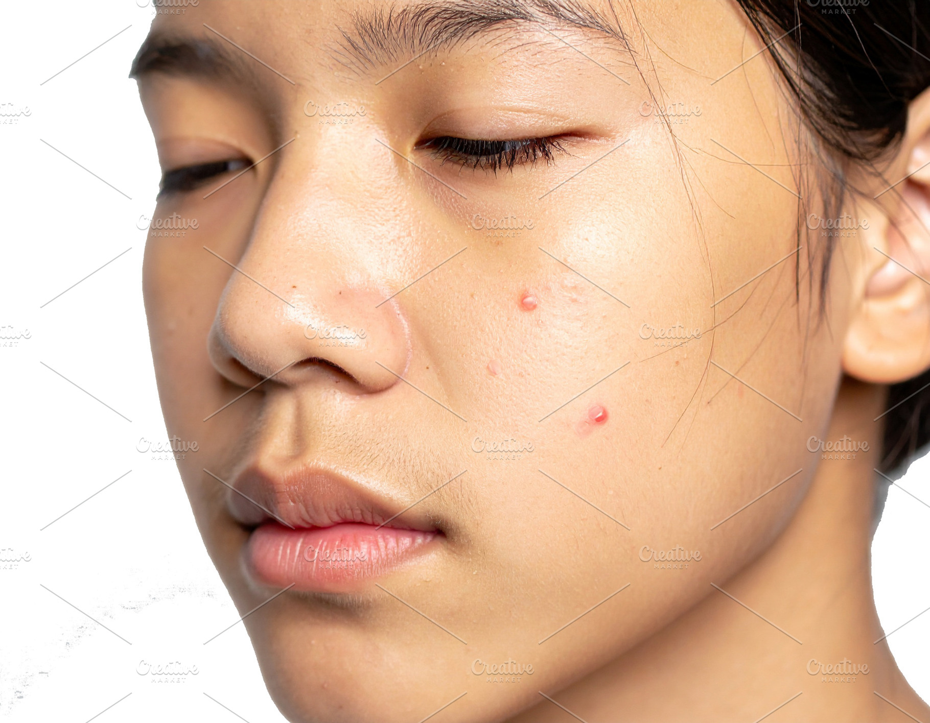 Young person with pimples on his cheek, a Person Photo by DanFLCreativo