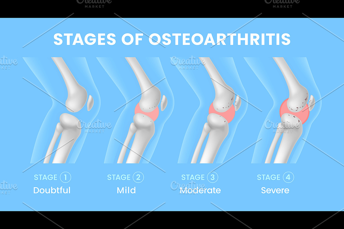 Knee joint osteoarthritis stages, a Healthcare Illustration by Seavector Studio (Photo 3 of 3)
