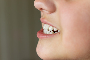 Malocclusion or child's teeth