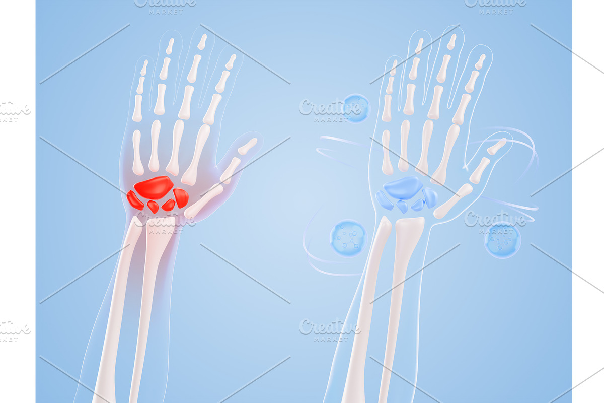 3D hand bone anatomy - wrist pain, a Healthcare Illustration by Marozhkastudio
