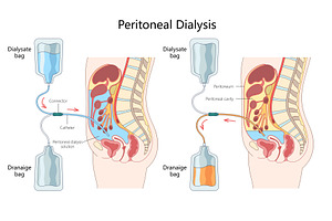 Peritoneal Dialysis Process medical, a Healthcare Illustration by AlexArt