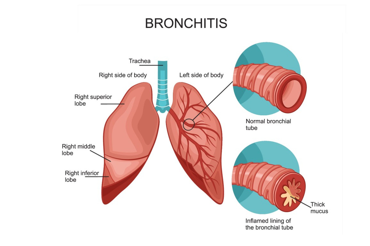 bronchitis, a Healthcare Illustration by logika 600