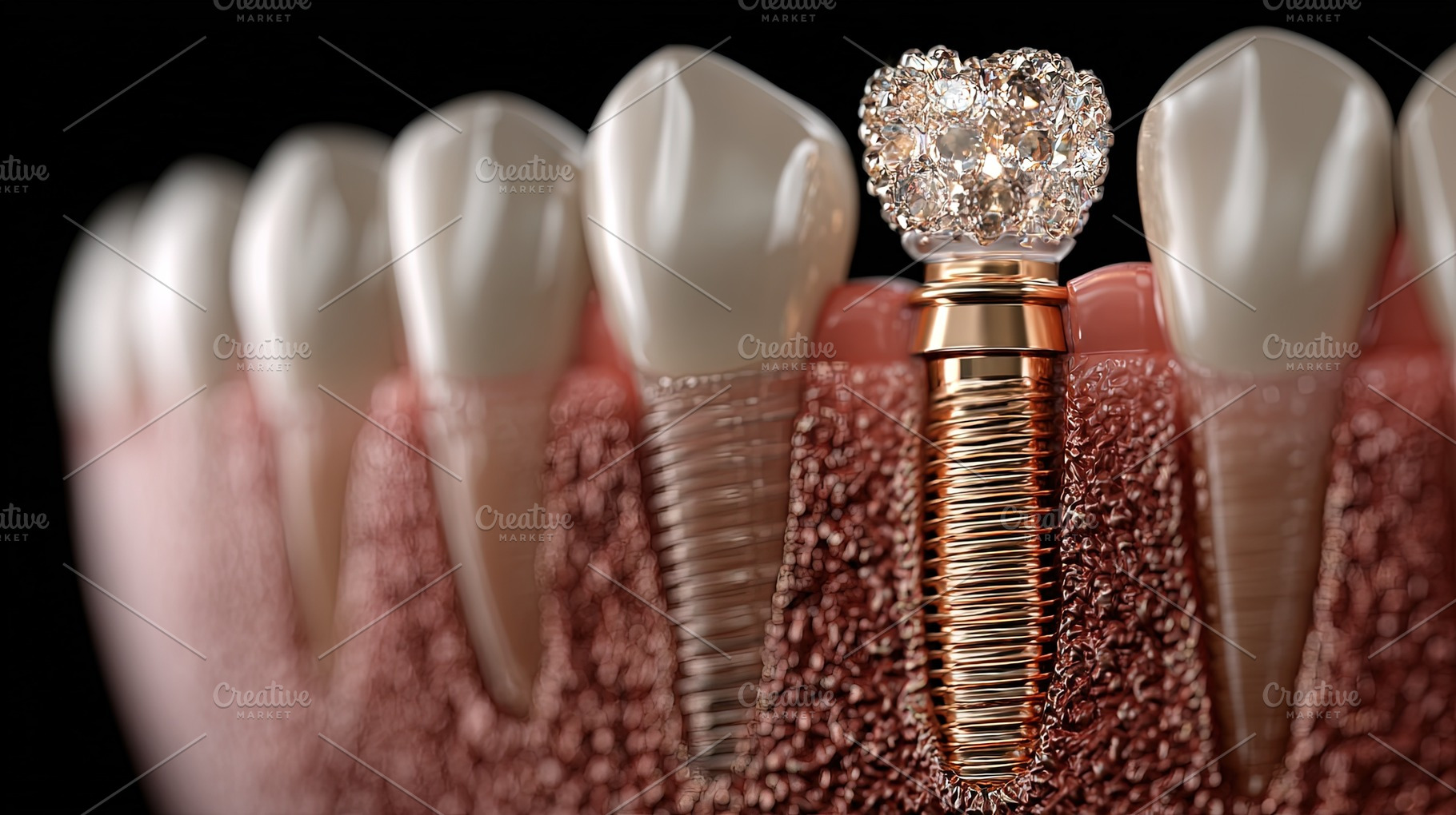 Dental Implant with Crown, a Health & Medical Photo by Ales Munt