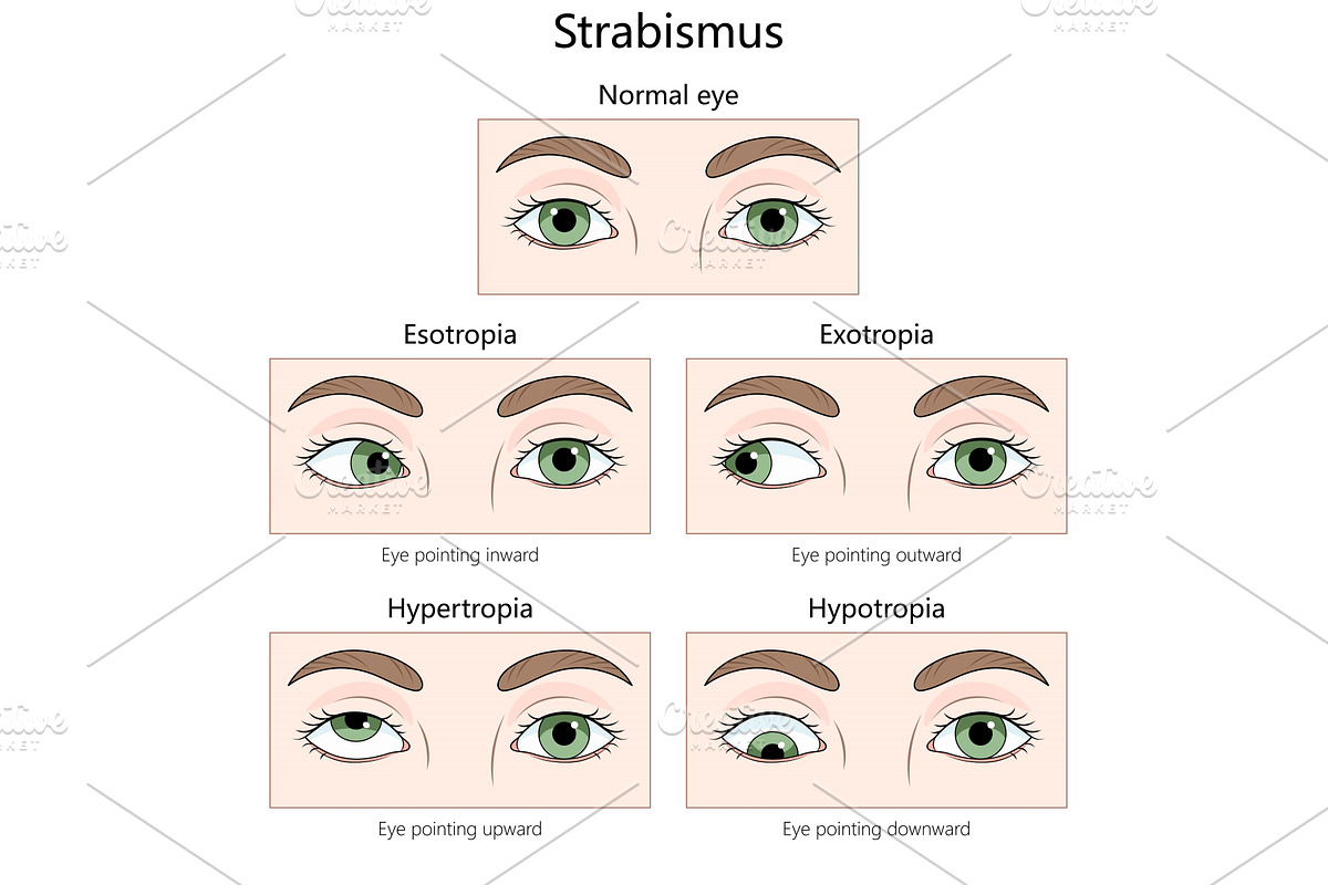 Types of Strabismus Eye Misalignment, a Healthcare Illustration by AlexArt